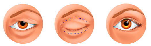Lidkorrektur Wolfsburg